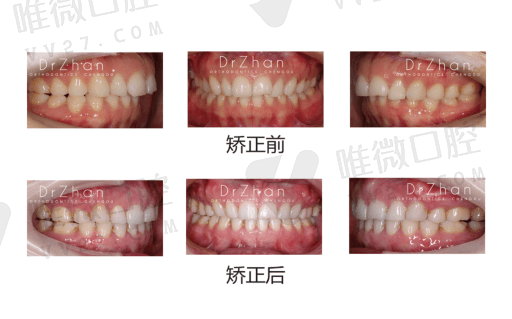 陶瓷假牙和烤瓷牙有什么区别,全瓷牙跟烤瓷牙哪个好(图1)